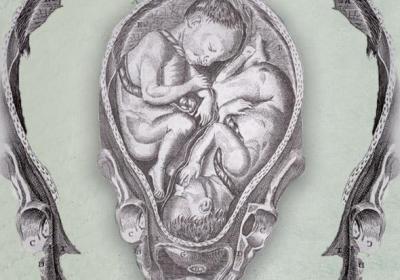 embryo twins